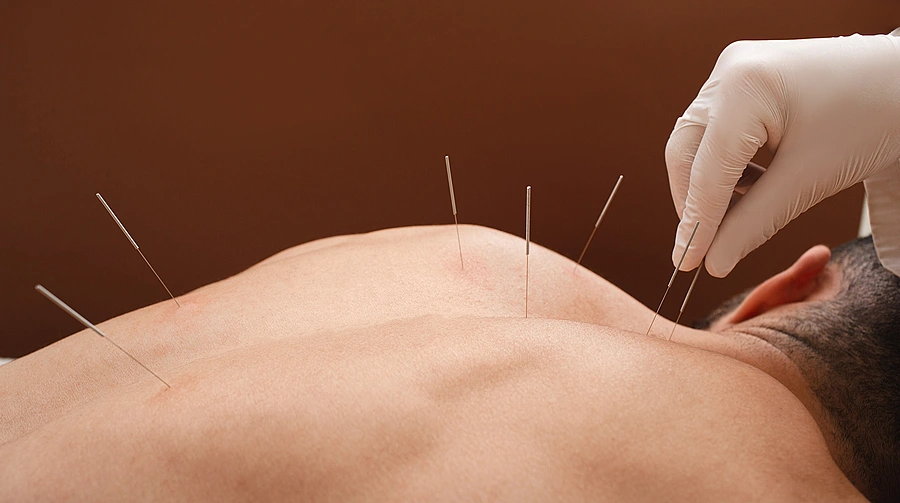 Acupuncture to treat Erectile Dysfunction: Myth or Reality?